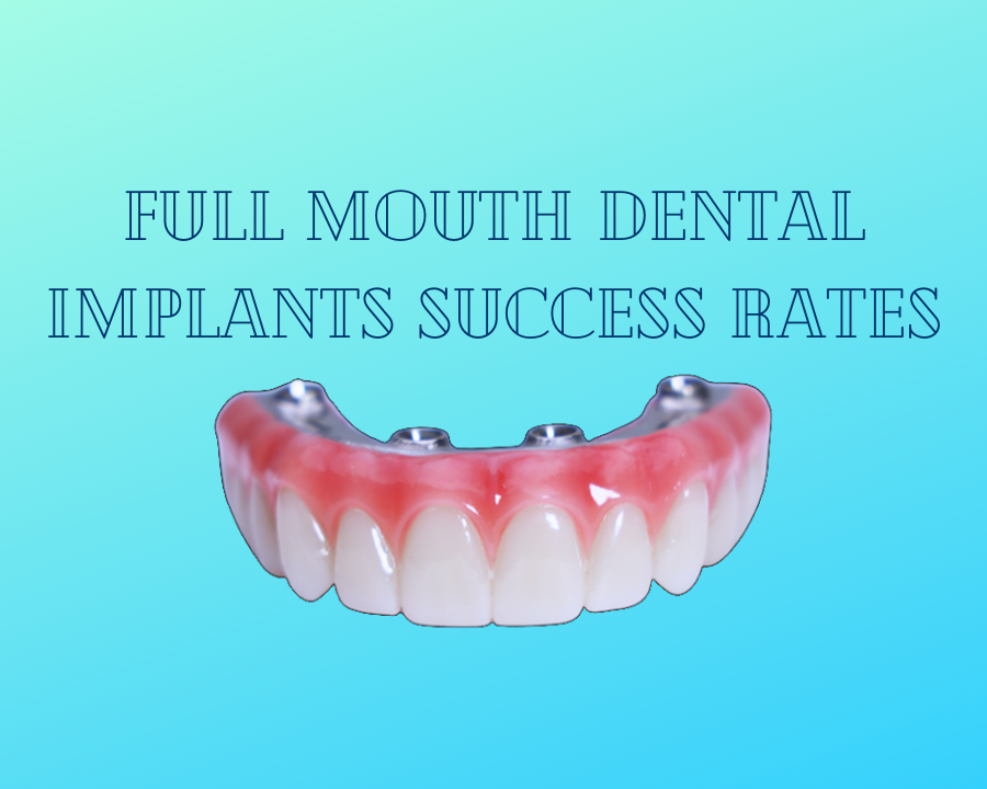What You Need To Know About Full Mouth Dental Implants Success Rates